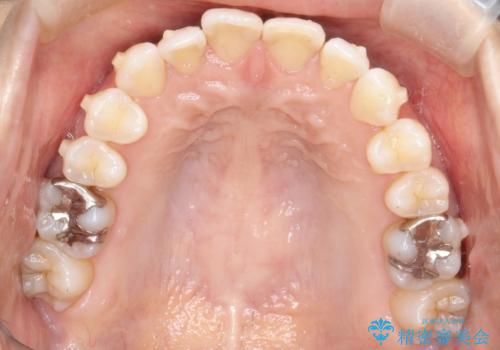八重歯と前歯のガタガタをインビザラインでの治療中