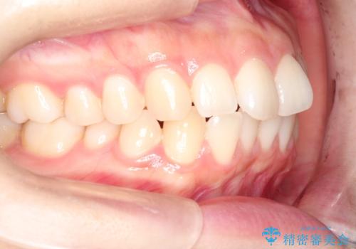 前歯のがたつきをインビザラインで目立たない矯正の治療前