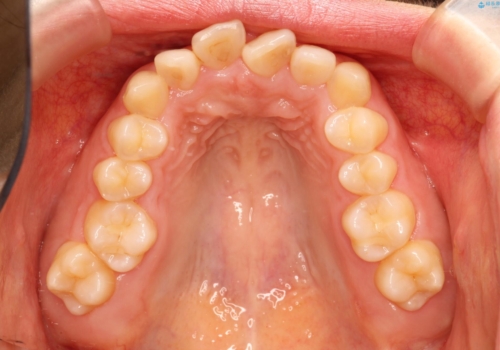 【出っ歯(飛び出した前歯)・がたつきでお悩みの方必見】インビザライン矯正の症例の治療前