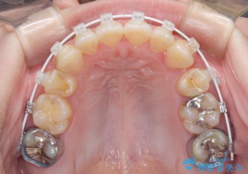 八重歯と前歯の欠損と骨格のズレ 目立たないワイヤー矯正の治療中