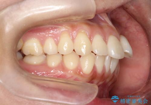 【審美ワイヤー】短期間で矯正完了の治療前