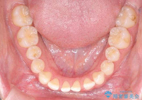 すきっ歯をインビザラインで目立たたずストレスなく矯正の治療前