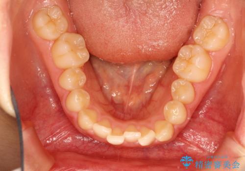 【出っ歯(飛び出した前歯)・がたつきでお悩みの方必見】インビザライン矯正の症例の治療前