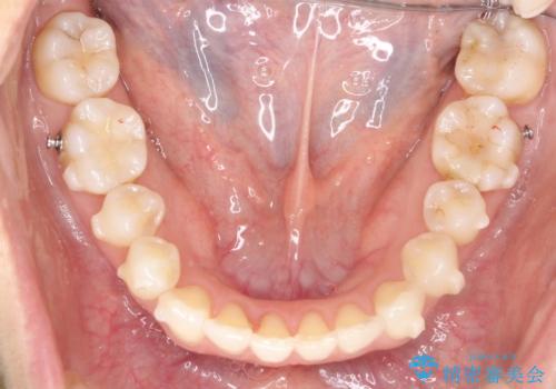 八重歯と前歯のガタガタをインビザラインでの治療中