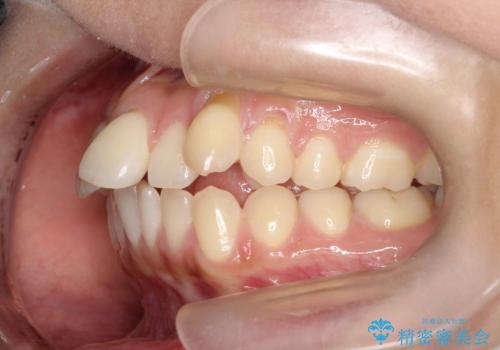 【審美ワイヤー】短期間で矯正完了の治療前