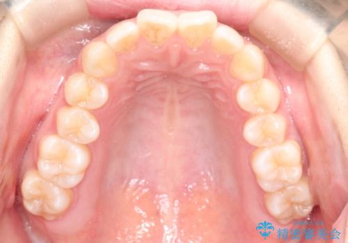 前歯のがたつきをインビザラインで目立たない矯正の症例 治療前
