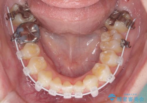 八重歯と前歯の欠損と骨格のズレ　目立たないワイヤー矯正の治療中
