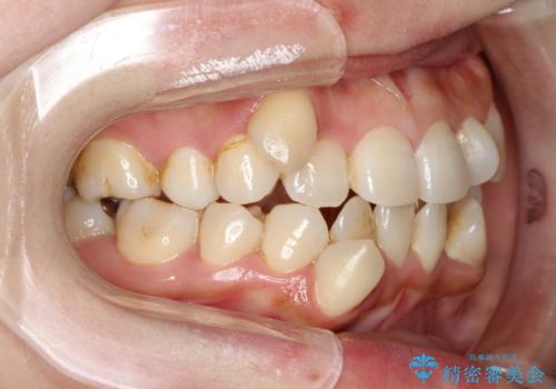 コンプレックスだった前歯のガタガタがここまで綺麗になるなんて!!の治療前