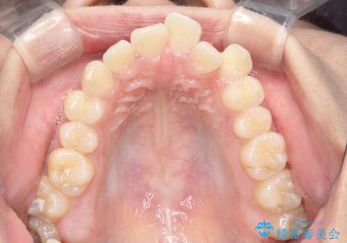 【審美ワイヤー】短期間で矯正完了の治療前