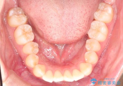 前歯のがたつきをインビザラインで目立たない矯正の治療前