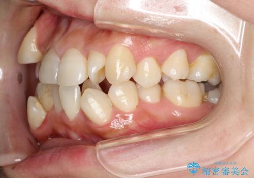 コンプレックスだった前歯のガタガタがここまで綺麗になるなんて!!の治療前