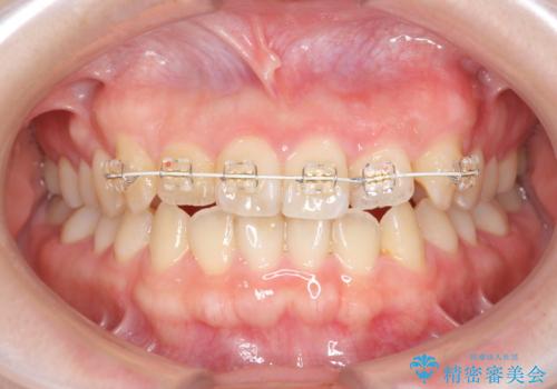 前歯のねじれを治したい (部分矯正を併用したマウスピース矯正)の治療中