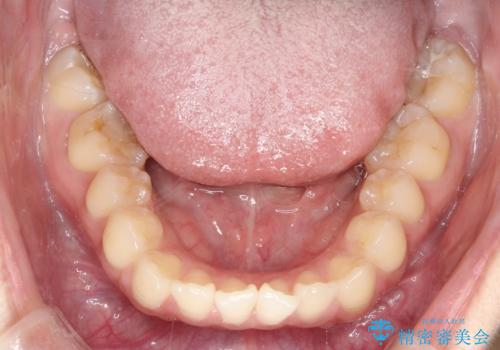 【審美ワイヤー】短期間で矯正完了の治療前
