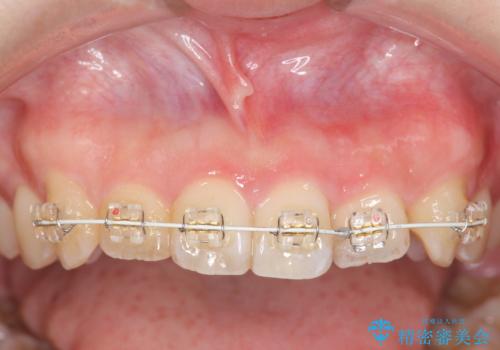 前歯のねじれを改善 小矯正+マウスピース矯正インビザラインの治療中