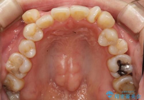 コンプレックスだった前歯のガタガタがここまで綺麗になるなんて!!の治療前