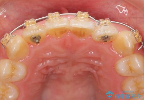 前歯のねじれを治したい (部分矯正を併用したマウスピース矯正)の治療中