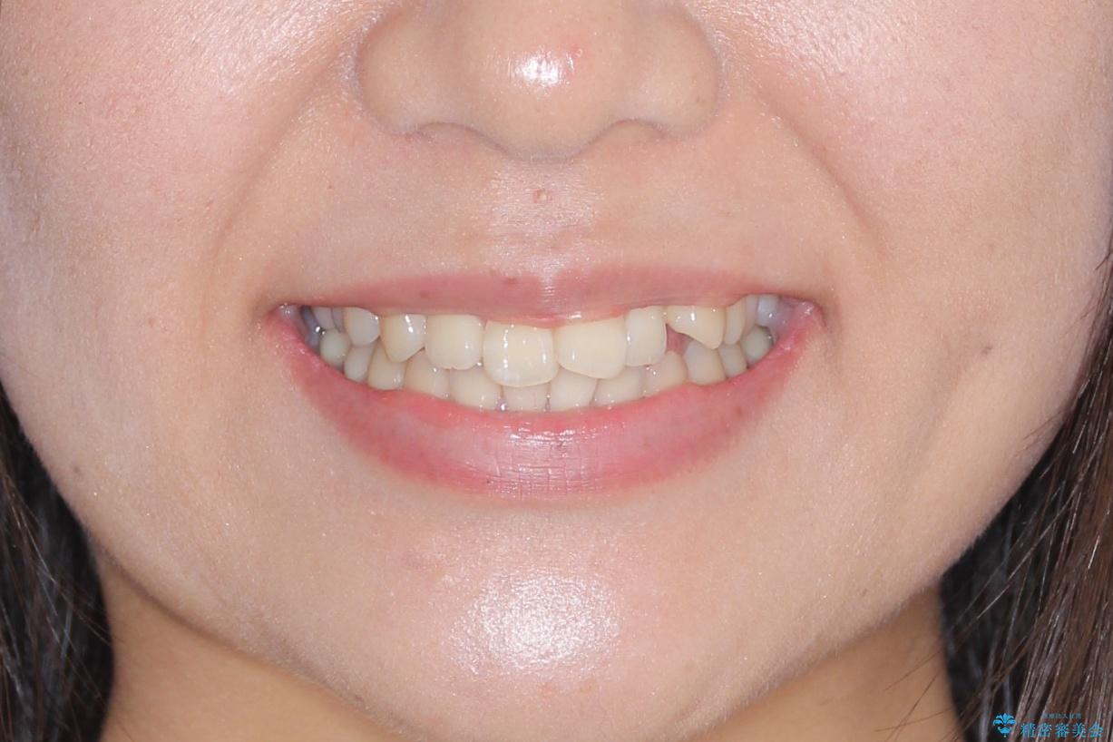 【審美ワイヤー】短期間で矯正完了の治療前(顔貌)