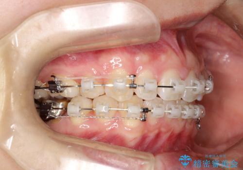 出っ歯の矯正　抜歯をしてしっかり引っ込めるワイヤー矯正の治療中