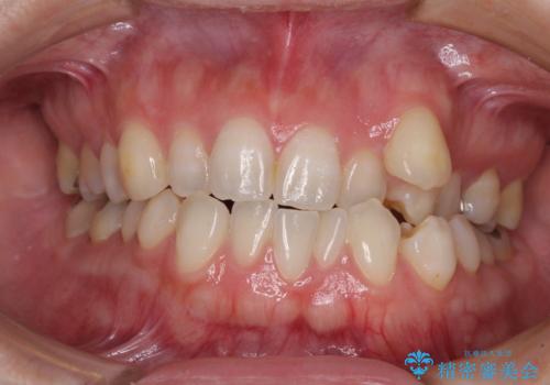 八重歯と前歯の欠損と骨格のズレ　目立たないワイヤー矯正の治療前