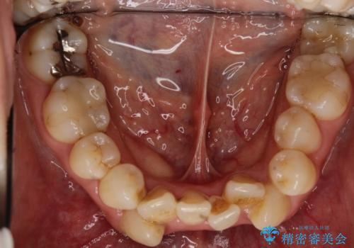 コンプレックスだった前歯のガタガタがここまで綺麗になるなんて!!の治療前