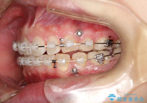 出っ歯の矯正 抜歯をしてしっかり引っ込めるワイヤー矯正の治療中