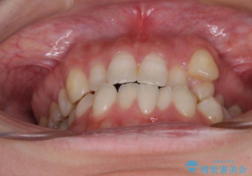八重歯と前歯の欠損と骨格のズレ 目立たないワイヤー矯正の治療前