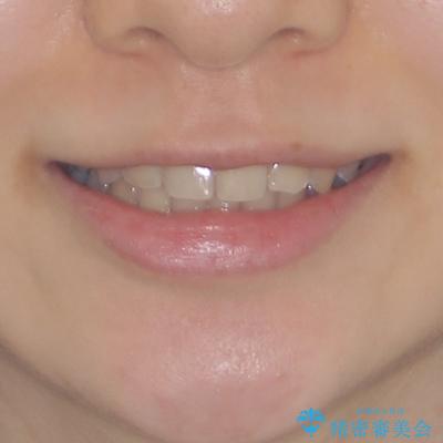 楽してクロスバイトを治したい ワイヤー装置による矯正治療の治療後(顔貌)