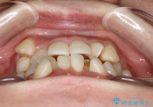 コンプレックスだった前歯のガタガタがここまで綺麗になるなんて!!の治療前