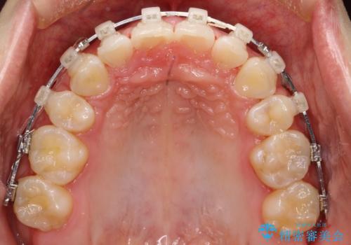 出っ歯の矯正 抜歯をしてしっかり引っ込めるワイヤー矯正の治療中