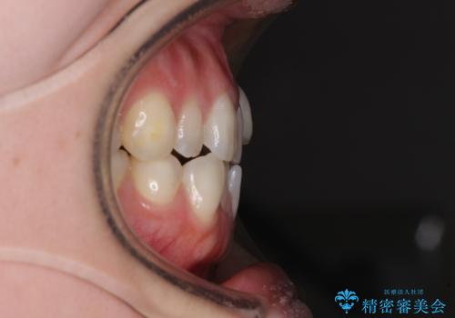 八重歯と前歯の欠損と骨格のズレ 目立たないワイヤー矯正の治療前