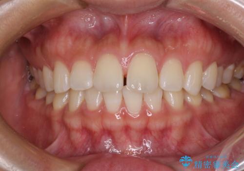 【モニター】前歯のすきっ歯をインビザラインで改善の症例 治療前