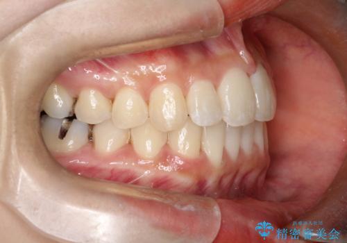 【すきっ歯・引っ込んだ前歯でお悩みの方必見】インビザライン矯正の症例の治療後