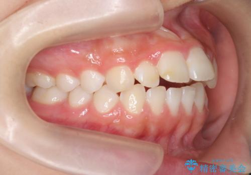 [ 出っ歯を治したい ]   マウスピース矯正での上顎前突治療の治療前
