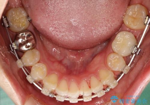 出っ歯の矯正　抜歯をしてしっかり引っ込めるワイヤー矯正の治療中