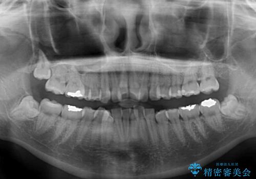 デコボコで飛び出した前歯 ワイヤー装置による抜歯矯正の治療前