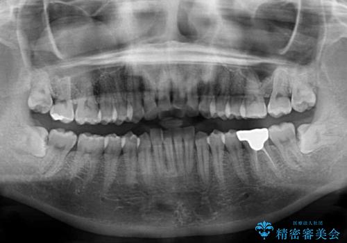 出産をしながら歯列を整える インビザラインによる矯正治療の治療前