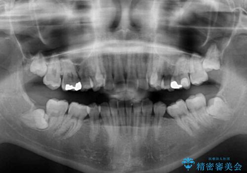 著しい八重歯を短期間で改善　ワイヤー装置による抜歯矯正の治療前