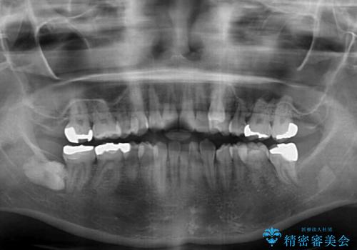 八重歯と前歯の欠損と骨格のズレ　目立たないワイヤー矯正の治療前