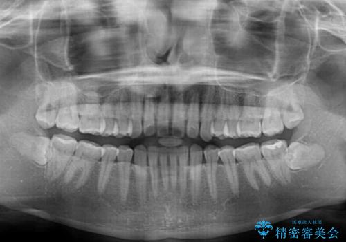 【モニター】前歯のすきっ歯をインビザラインで改善の治療前