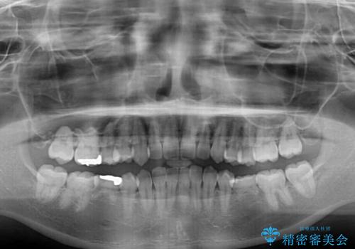 楽してクロスバイトを治したい ワイヤー装置による矯正治療の治療前