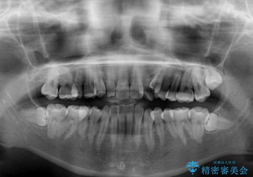 補助装置を併用したインビザラインでの八重歯の抜歯矯正の治療前