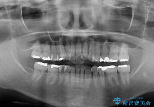 八重歯と形の悪い前歯 矯正治療とセラミック治療の治療前