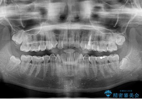 前歯のクロスバイト 目立たないワイヤー装置で速やかに矯正治療の治療前