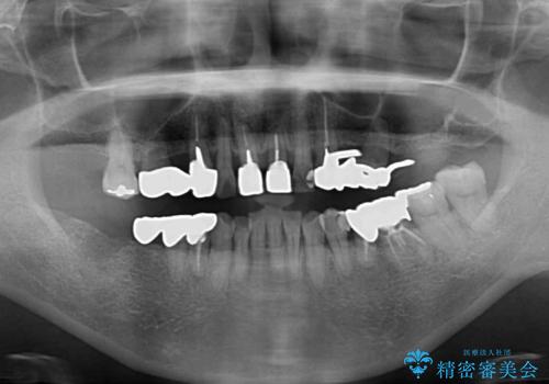 銀歯や入れ歯で汚い歯をきれいにしたい 総合歯科治療の治療前