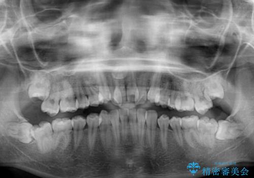 骨格的なズレをカムフラージュ 抜歯矯正で咬み合わせを改善の治療前