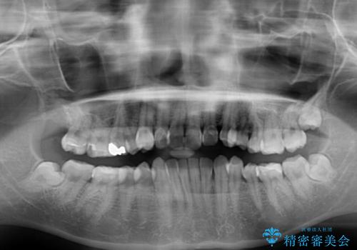 デコボコ歯列をきれいに インビザラインによる矯正治療の治療前