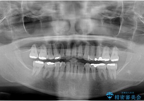 八重歯と形の悪い前歯 矯正治療とセラミック治療の治療後