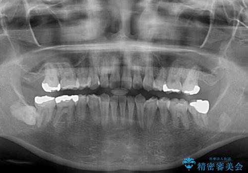 八重歯と前歯の欠損と骨格のズレ 目立たないワイヤー矯正の治療後