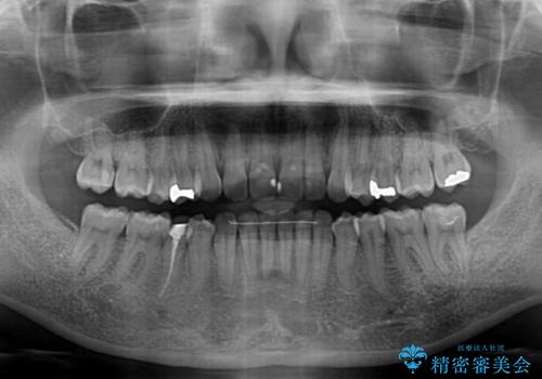 前歯の叢生をいつの間にか改善 インビザラインによる矯正治療の治療後