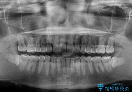 【モニター】前歯のすきっ歯をインビザラインで改善の治療後